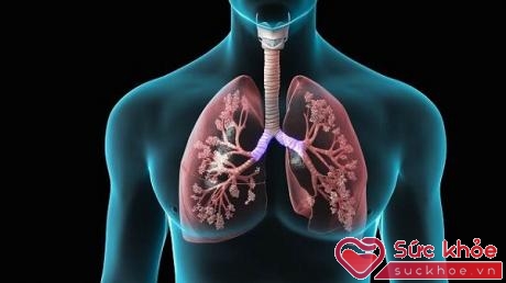 Suy giảm chức năng phổi diễn ra chậm hơn ở những người đã từng hút thuốc lá có chế độ ăn nhiều trái cây.