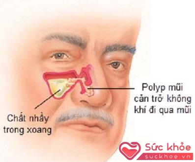 Vị trí polyp mũi làm ảnh hưởng đến đường thở.