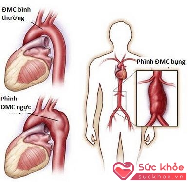 Phình ĐMC là căn bệnh rất nguy hiểm, có tỷ lệ tử vong cao.