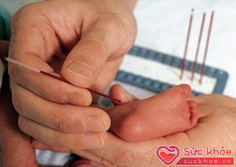 Việc sàng lọc sơ sinh bệnh PKU là một trong những xét nghiệm sàng lọc quan trọng bắt buộc phải thực hiện ngay sau sinh để giảm thiểu di chứng do bệnh mang lại.