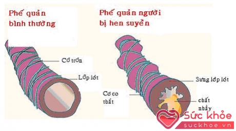 Các cơn hen cấp khiến người bệnh rất khó thở.