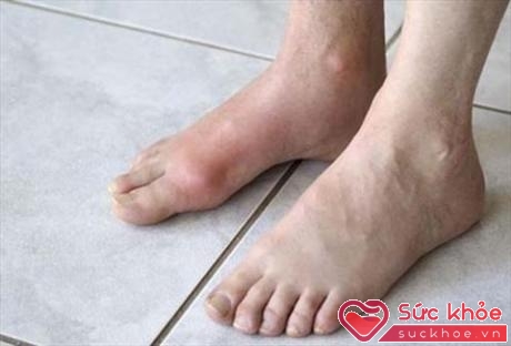 Với người có bệnh lý đái tháo đường nên tự kiểm tra bàn chân mỗi ngày