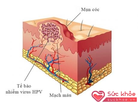 Mụn cơm (hay mụn cóc) do virut HPV gây nên.