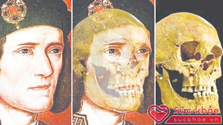 Nhờ xét nghiệm AND người ta biết được vị trí chôn cất Vua Richard III