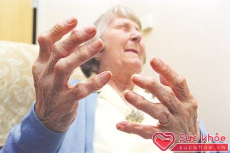Viêm khớp dạng thấp có thể gây biến dạng khớp, co quắp các ngón tay