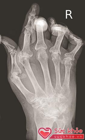 Chụp X- quang các khớp đau sẽ thấy có hình ảnh biến đổi xương
