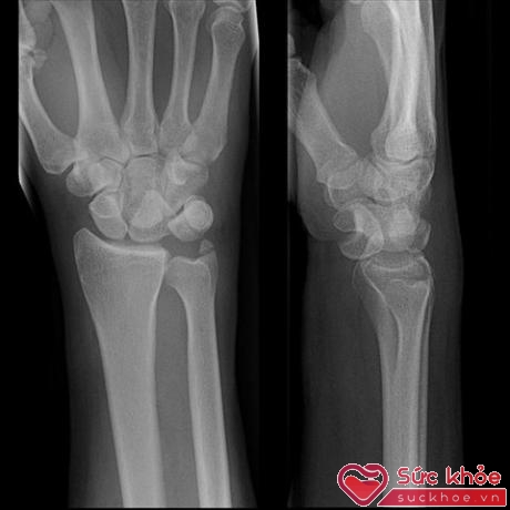 Trong các tổn thương do trật khớp, trật khớp thường diễn ra ở vai và các ngón tay là chủ yếu.