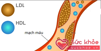 Cholesterol xấu LDL gây xơ vữa mạch máu (hình tròn nhỏ) và cholesterol tốt HDL (hình tròn to)