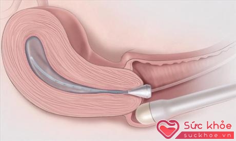 Hở eo tử cung là hiện tượng phần tiếp nối giữa cổ tử cung và tử cung bị hở ra do không chịu được áp lực nặng nề của túi ối khi thai nhi phát triển.
