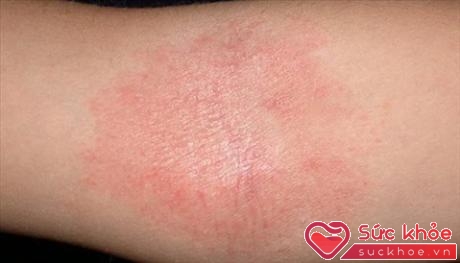 Những mảng đỏ, mẩn ngứa có thể báo hiệu rất nhiều bệnh ngoài da.