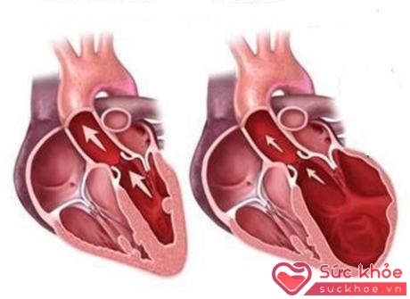 Khi trẻ bị thấp tim có thể bị viêm tim toàn bộ (tổn thương viêm ở cơ tim, ở màng tim và màng ngoài tim)