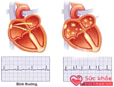 Hình ảnh sóng điện tim bình thường (trái) và khi bị rung nhĩ