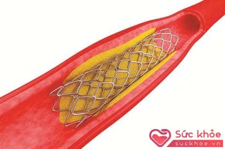 Đặt giá đỡ (stent) làm cho chỗ hẹp rộng ra, máu lưu thông dễ dàng