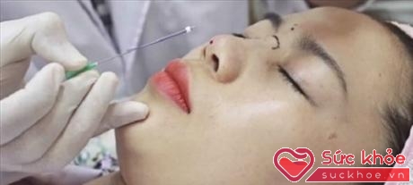 Việc nâng mũi bằng phương pháp chỉ sinh học cần được thực hiện bởi bác sĩ có tay nghề chuyên môn và chọn chỉ có chất lượng được kiểm định.