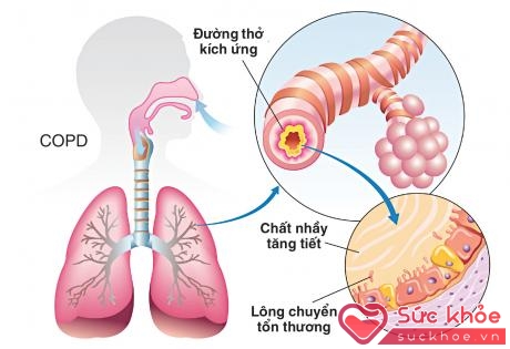 Chất nhầy ở bệnh nhân COPD có thể dẫn đến nghẹt thở khi ngủ.