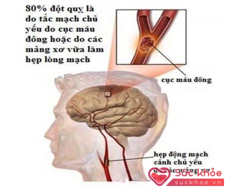 Bệnh lý chính của mạch máu não là huyết khối trên nền vữa xơ mạch máu.