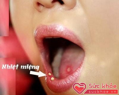 Loét miệng áp-tơ thường lành tính nhưng gây đau đớn cho bệnh nhân.