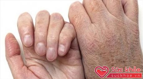 Bàn tay khô nứt có thể là dấu hiệu ung thư