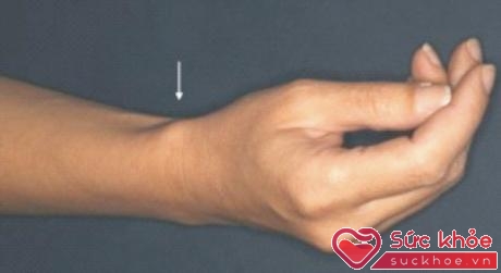 Vị trí sưng đau trong bệnh “viêm hẹp bao gân của ngón tay cái ở vùng cổ tay”