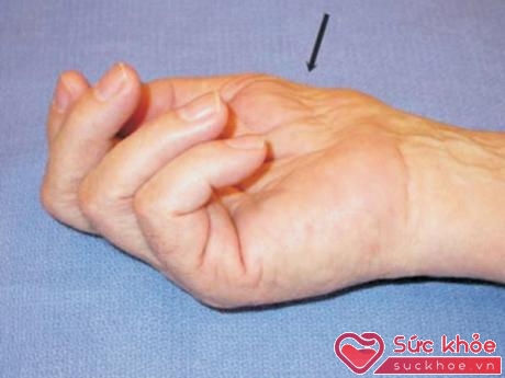 Teo cơ ngón tay cái do bệnh “hội chứng ống cổ tay” không được điều trị