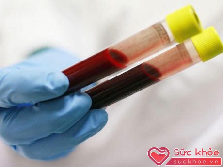 Xét nghiệm máu phát hiện bilirubin giúp chẩn đoán vàng da.