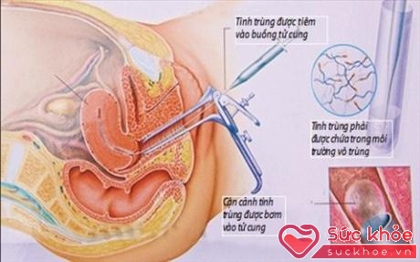Thụ tinh bằng phương pháp bơm tinh trùng vào buồng tử cung (Ảnh: Internet)