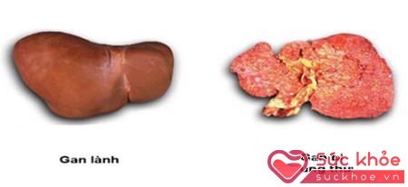 Sự khác biệt giữa gan bình thường và gan bị ung thư (Ảnh minh họa: Internet)