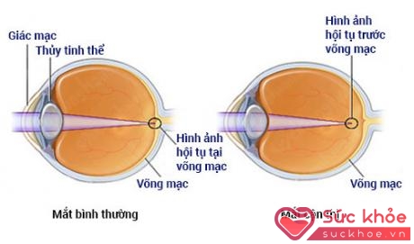 Cận thị là sự mất cân bằng giữa chiều dài trục nhãn cầu và công suất khúc xạ của mắt