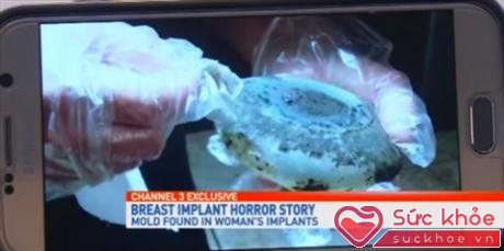 Miếng độ silicon bị nấm mốc trong ngực mẹ khiến bé trai suýt chết khi bú sữa