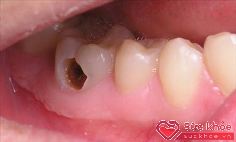 Nếu gặp các vấn đề về răng miệng, tuyệt đối không nên 'tự xử' ở nhà (ảnh minh họa: Internet)