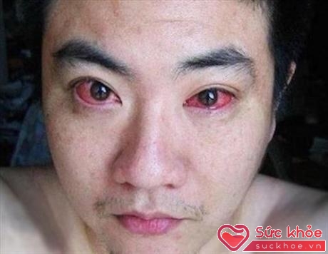 Một người đàn ông 40 tuổi đã bị chẩn đoán ung thư mắt vì thói quen sử dụng điện thoại thông minh vào ban đêm khi tắt đèn đi ngủ. (ảnh minh họa: Internet)