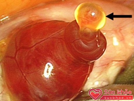 Trong khi một số phụ nữ nhận biết được ngày trứng rụng của mình thì không ít chị em gặp nhiều khó khăn trong việc này. (ảnh minh họa)