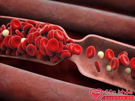 Các vấn đề về mạch máu có mối quan hệ rất lớn đối với chế độ ăn uống.