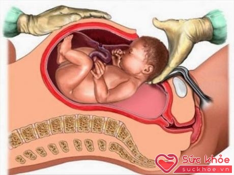 Rạch tầng sinh môn là thủ thuật giúp mở rộng âm đạo và âm hộ để thai ra ngoài dễ hơn.( Ảnh minh họa)