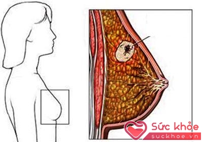 Nếu bổ sung estrogen không đúng cách có nguy cơ bị ung thư vú và tăng các bệnh huyết khối.