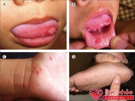 Các biểu hiện của bệnh tay chân miệng ở trẻ (Ảnh: Markmedicalsupplies)