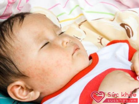 Các triệu chứng sốt phát ban ở trẻ em cần xử lý kịp thời