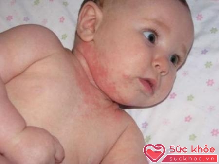 Khi trẻ bị sốt và sau đó xuất hiện điểm nổi mẩn đỏ, có thể là những triệu chứng sốt phát ban ở trẻ nhỏ