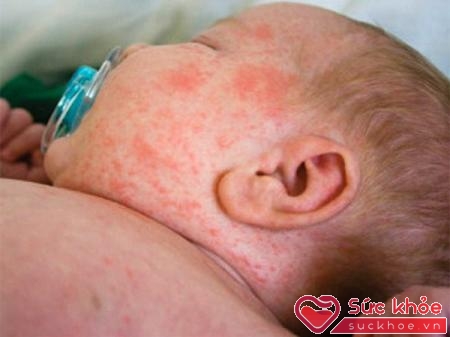 Bố mẹ cần sớm nhận biết các triệu chứng sốt phát ban ở trẻ em