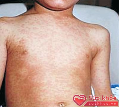 Triệu chứng sốt phát ban ở người lớn như nổi mẩn đỏ, sốt, sưng hạch