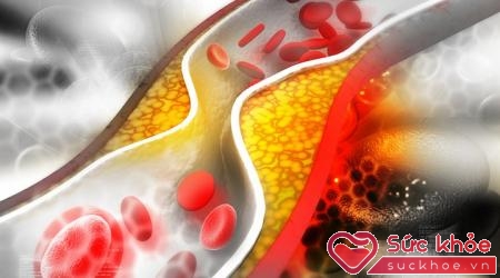 Cholesterol cao là yếu tố hàng đầu trong nguyên nhân bệnh tim mạch