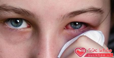 Đau mắt đỏ ở trẻ em cần vệ sinh đúng cách