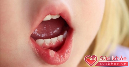 Loét miệng là triệu chứng bệnh tay chân miệng ở trẻ em