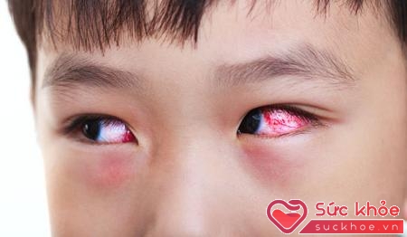 Đau mắt đỏ ở trẻ phải hết sức thận trọng