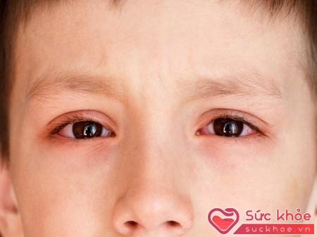 Triệu chứng phổ biến bệnh đau mắt đỏ ở trẻ em