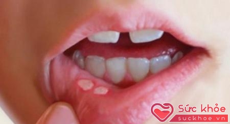 Loét miệng là một dấu hiệu bệnh tay chân miệng độ 1