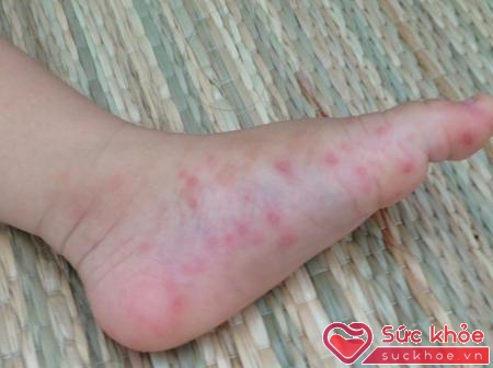 Nổi ban đỏ trên da là dấu hiệu bệnh tay chân miệng trẻ em