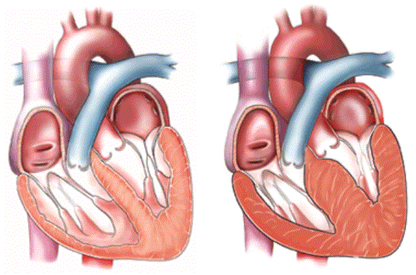 Cơ tim phì đại là một biến chứng cao huyết áp
