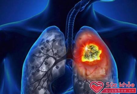 Nên điều trị ung thư phổi trong 2 giai đoạn đầu sẽ tăng tỷ lệ cứu sống người bệnh
