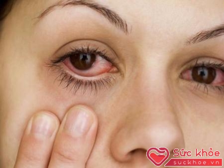 Mắt đỏ là một trong những triệu chứng bệnh đau mắt đỏ